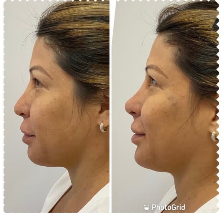 Depois — Resultado real