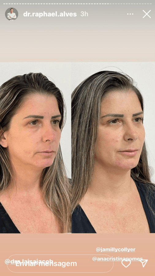 Depois — Resultado real