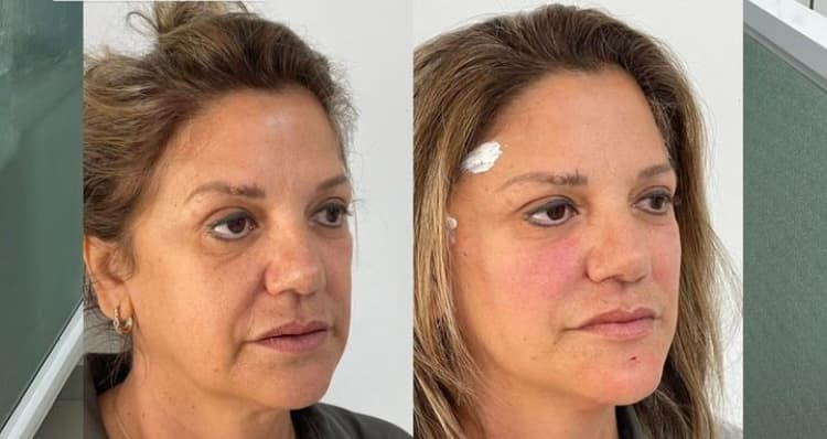 Depois — Resultado real